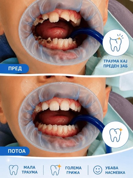 Пред и потоа — санирана траума кај преден заб (детска стоматологија)